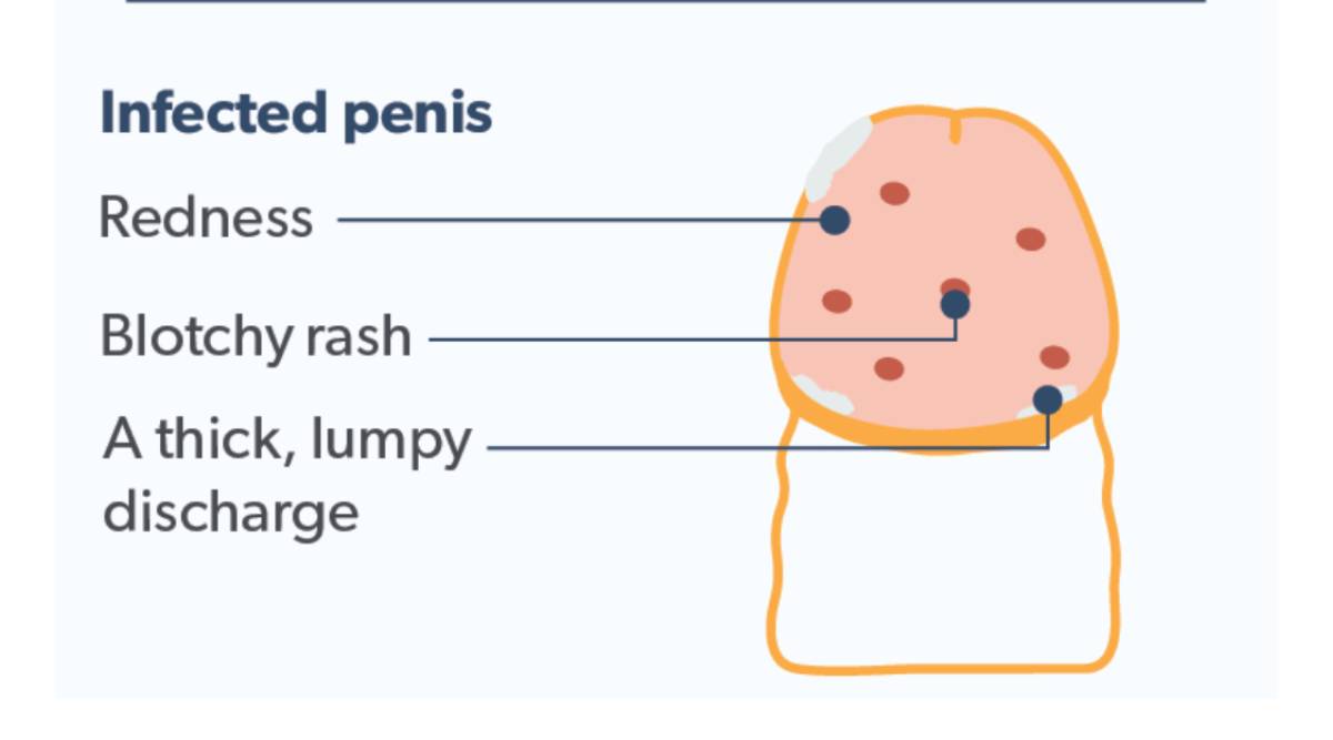 balanitis-infected