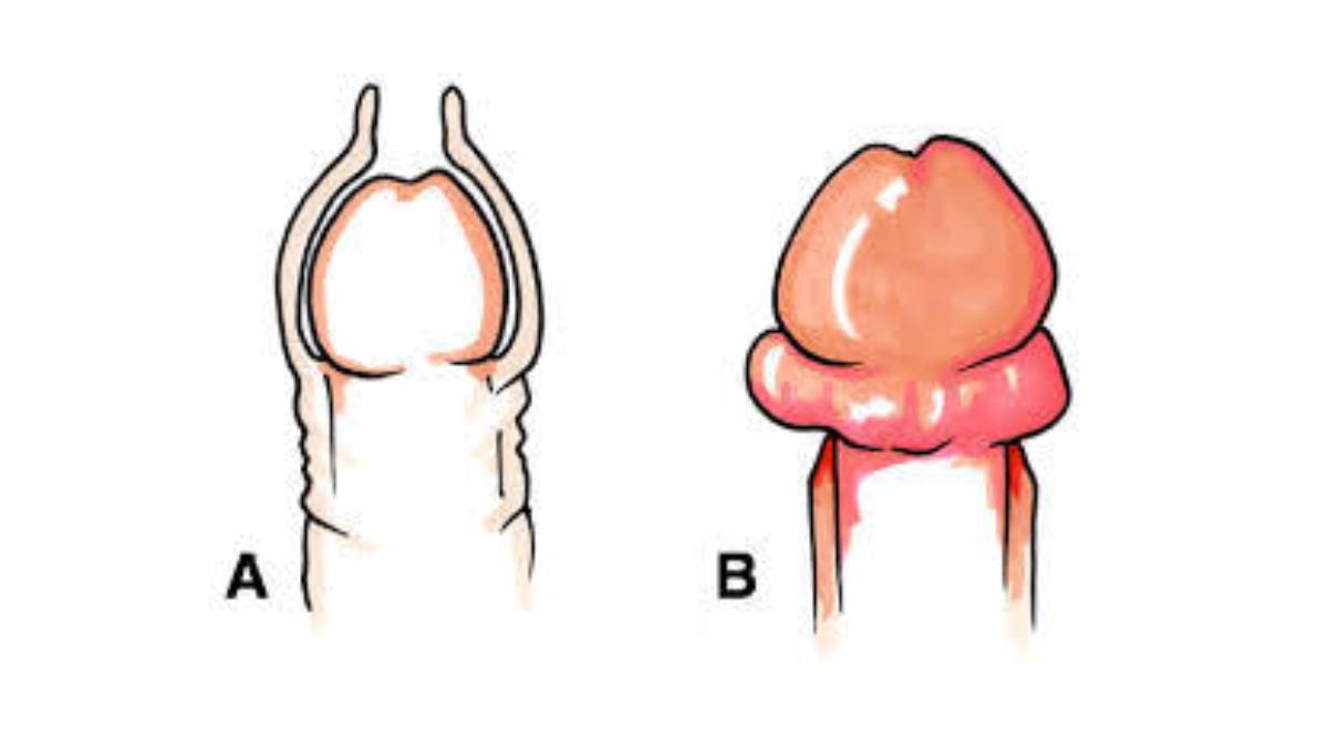 paraphimosis