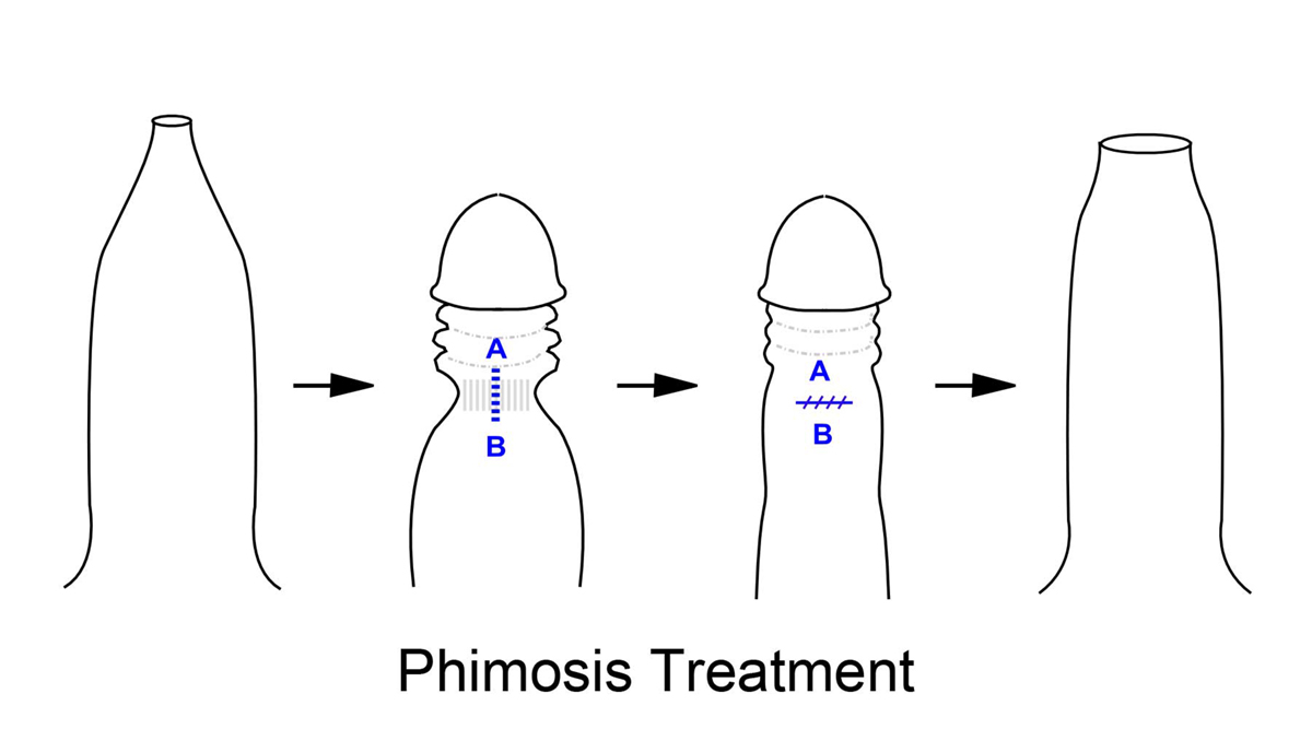 phimosis-treatment